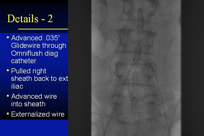 Details - 2 • Advanced. 035” Glidewire through Omniflush diag catheter • Pulled right