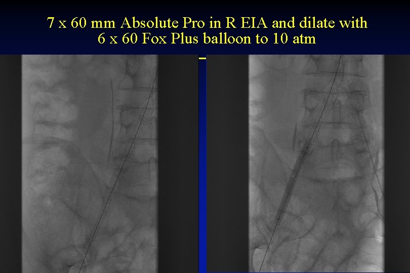 7 x 60 mm Absolute Pro in R EIA and dilate with 6 x