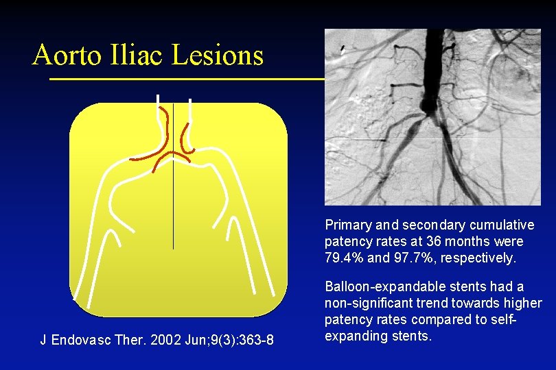 Aorto Iliac Lesions Primary and secondary cumulative patency rates at 36 months were 79.