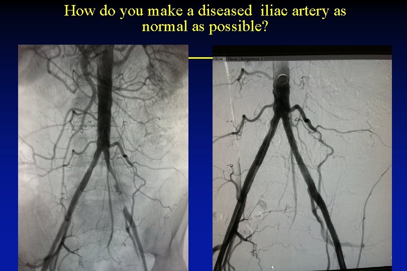 How do you make a diseased iliac artery as normal as possible? 