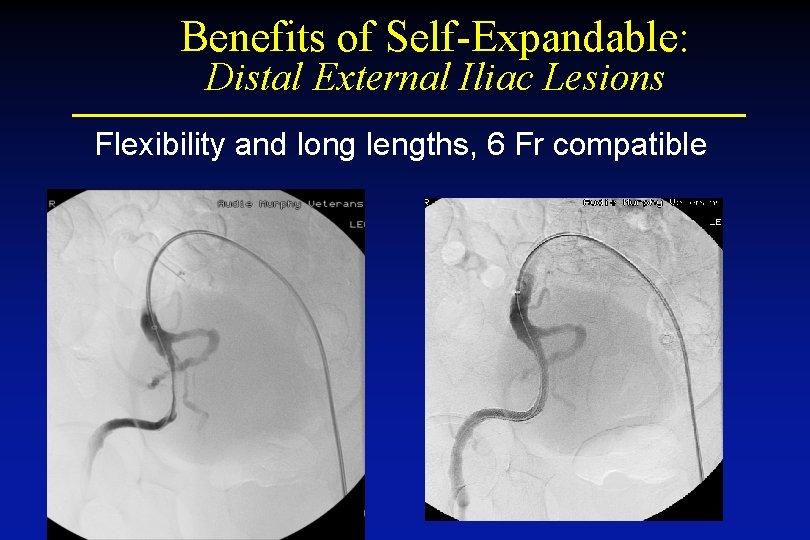 Benefits of Self-Expandable: Distal External Iliac Lesions Flexibility and long lengths, 6 Fr compatible