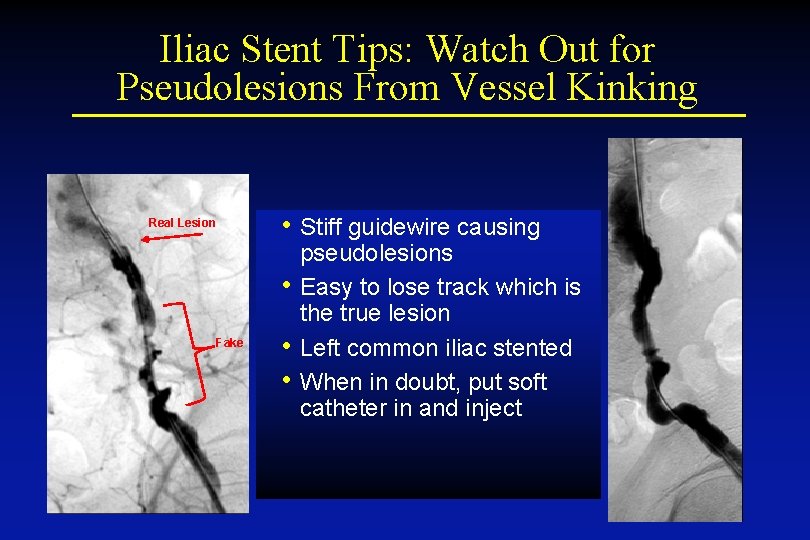 Iliac Stent Tips: Watch Out for Pseudolesions From Vessel Kinking • Stiff guidewire causing