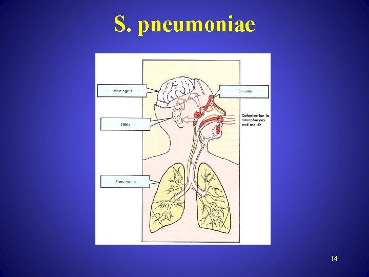 S. pneumoniae 14 