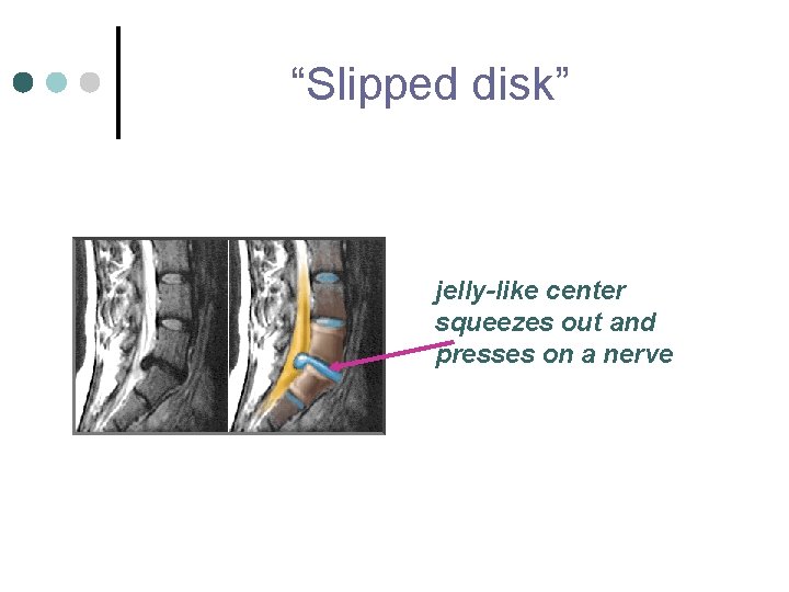 “Slipped disk” jelly-like center squeezes out and presses on a nerve 