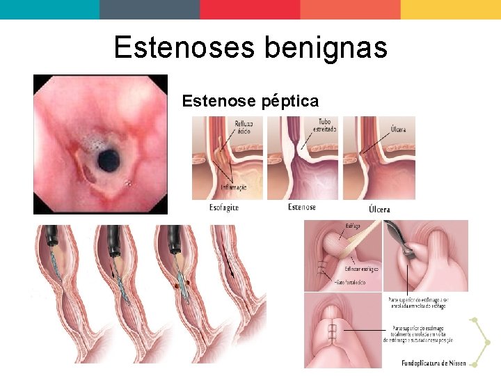 Estenoses benignas Estenose péptica 