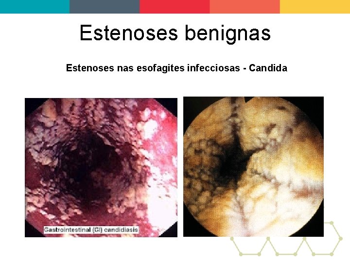 Estenoses benignas Estenoses nas esofagites infecciosas - Candida 