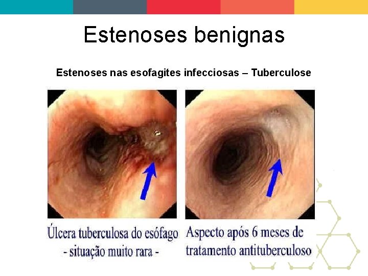 Estenoses benignas Estenoses nas esofagites infecciosas – Tuberculose 