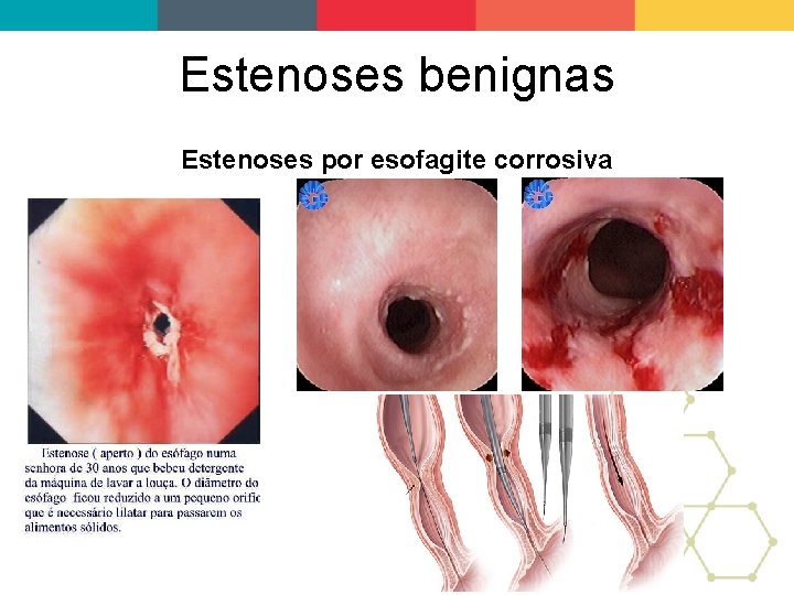 Estenoses benignas Estenoses por esofagite corrosiva 
