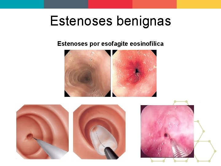 Estenoses benignas Estenoses por esofagite eosinofílica 