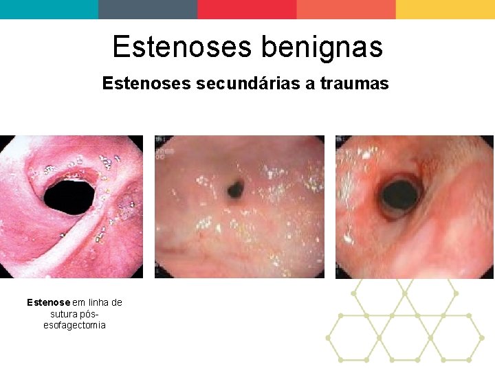 Estenoses benignas Estenoses secundárias a traumas Estenose em linha de sutura pósesofagectomia 