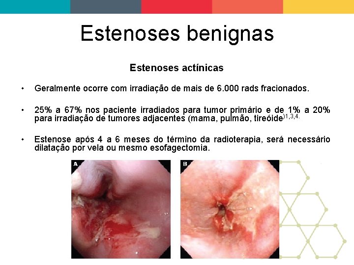 Estenoses benignas Estenoses actínicas • Geralmente ocorre com irradiação de mais de 6. 000