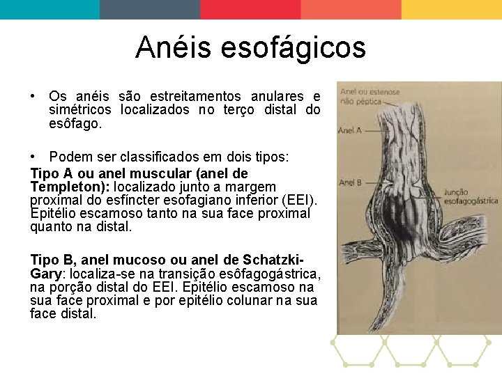 Anéis esofágicos • Os anéis são estreitamentos anulares e simétricos localizados no terço distal