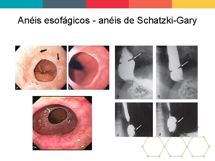 Anéis esofágicos - anéis de Schatzki-Gary 