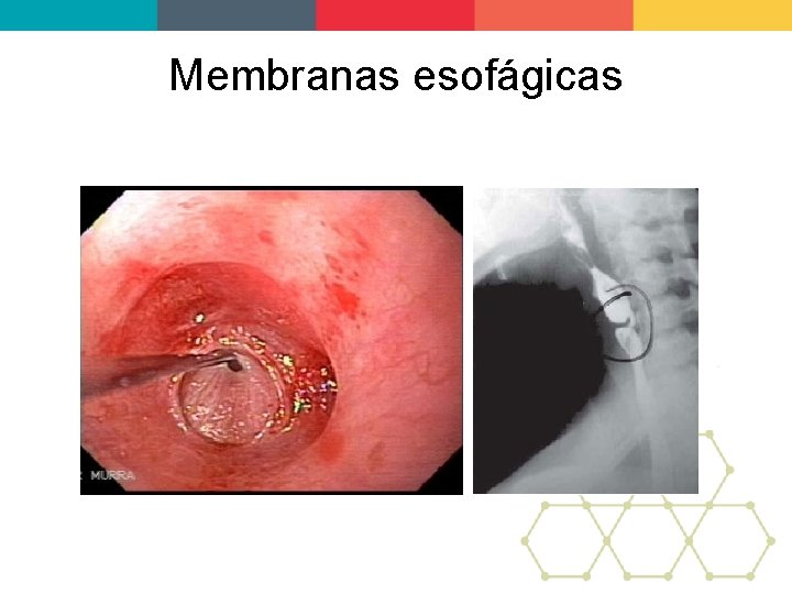 Membranas esofágicas 