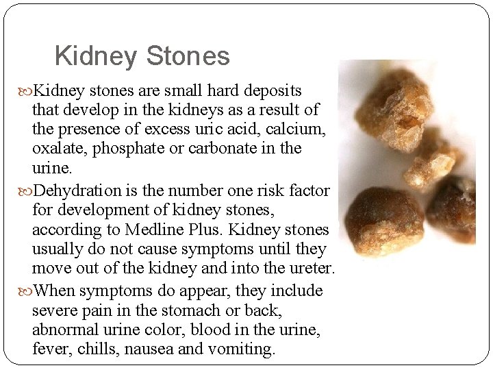 Kidney Stones Kidney stones are small hard deposits that develop in the kidneys as