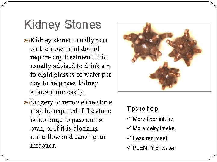 Kidney Stones Kidney stones usually pass on their own and do not require any