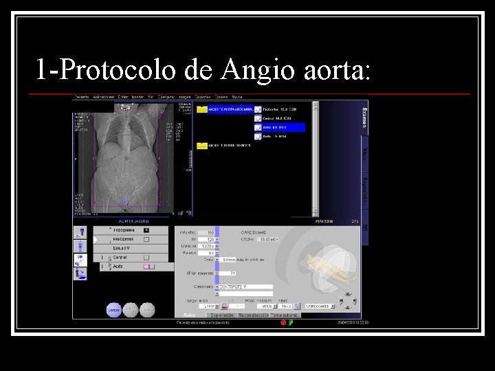 1 -Protocolo de Angio aorta: 