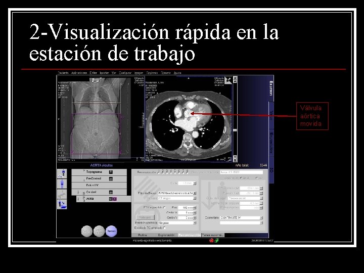 2 -Visualización rápida en la estación de trabajo Válvula aórtica movida 