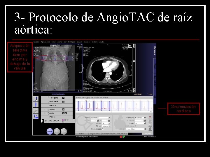 3 - Protocolo de Angio. TAC de raíz aórtica: Adquisición selectiva 4 cm por