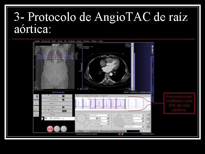 3 - Protocolo de Angio. TAC de raíz aórtica: Reconstrucción multifásica cada 10% del