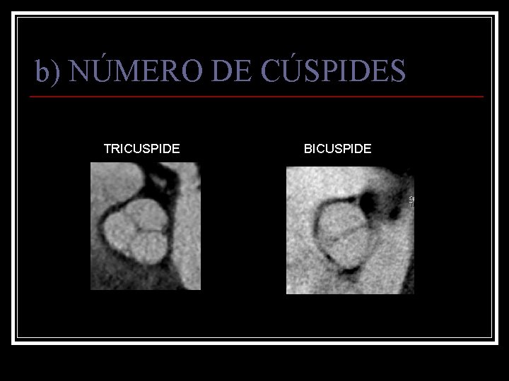 b) NÚMERO DE CÚSPIDES TRICUSPIDE BICUSPIDE 