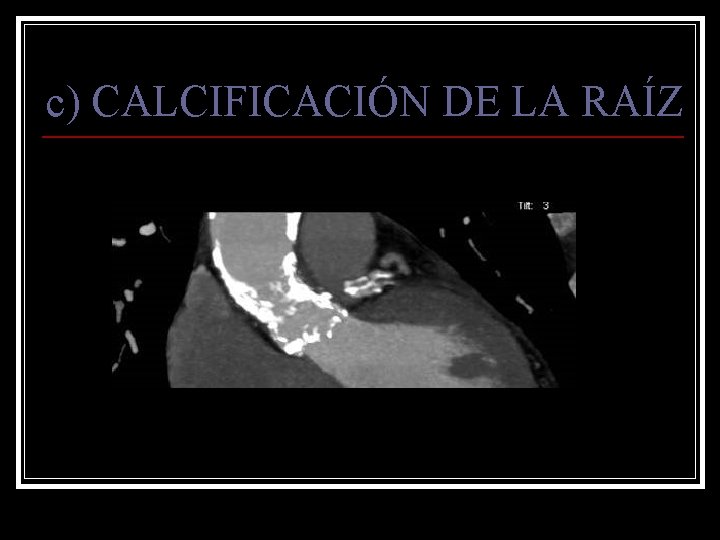 c) CALCIFICACIÓN DE LA RAÍZ 