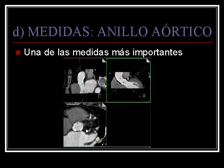 d) MEDIDAS: ANILLO AÓRTICO n Una de las medidas más importantes 