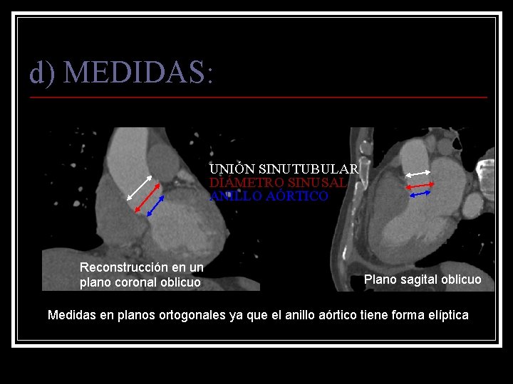 d) MEDIDAS: UNIÓN SINUTUBULAR DIÁMETRO SINUSAL ANILLO AÓRTICO Reconstrucción en un plano coronal oblicuo