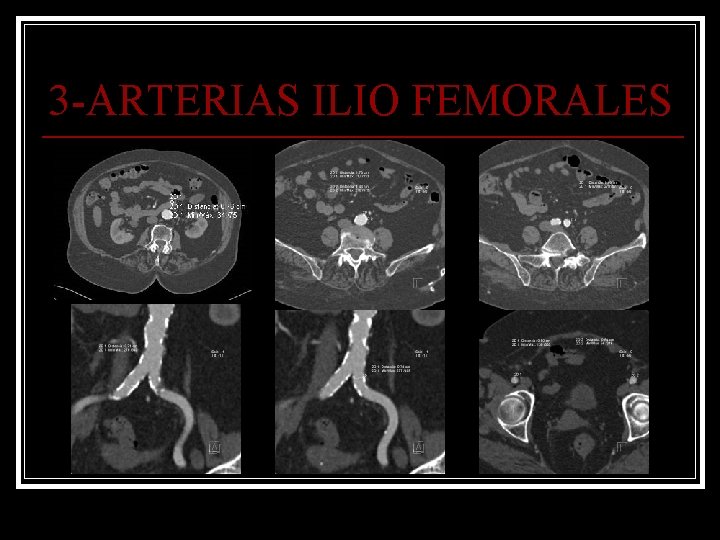 3 -ARTERIAS ILIO FEMORALES 