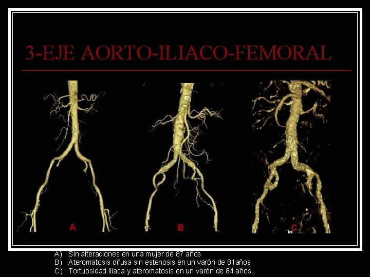 3 -EJE AORTO-ILIACO-FEMORAL A B A) Sin alteraciones en una mujer de 87 años