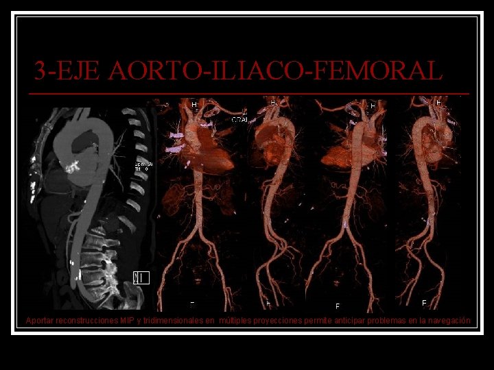 3 -EJE AORTO-ILIACO-FEMORAL Aportar reconstrucciones MIP y tridimensionales en múltiples proyecciones permite anticipar problemas