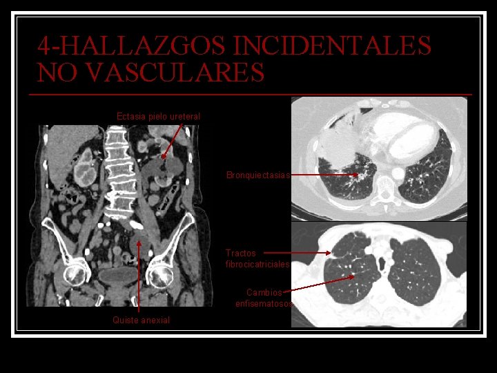 4 -HALLAZGOS INCIDENTALES NO VASCULARES Ectasia pielo ureteral Bronquiectasias Tractos fibrocicatriciales Cambios enfisematosos Quiste