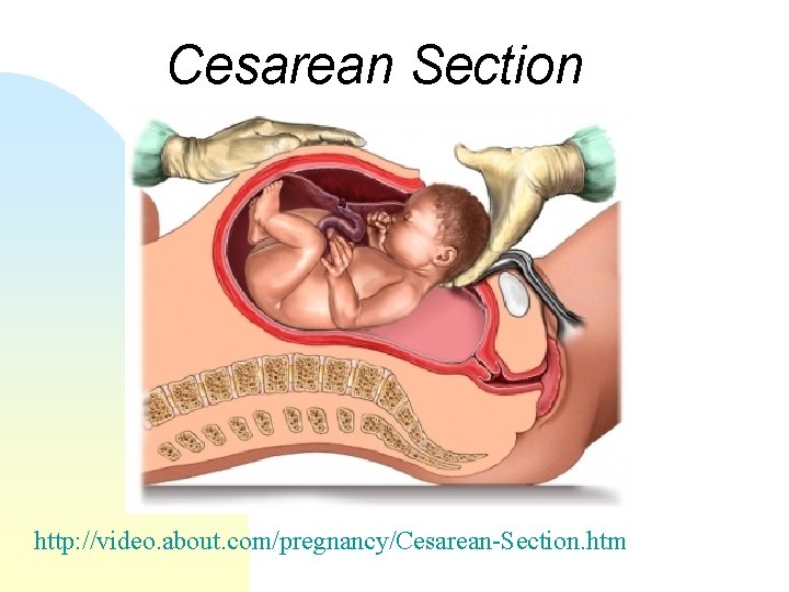 Cesarean Section http: //video. about. com/pregnancy/Cesarean-Section. htm 