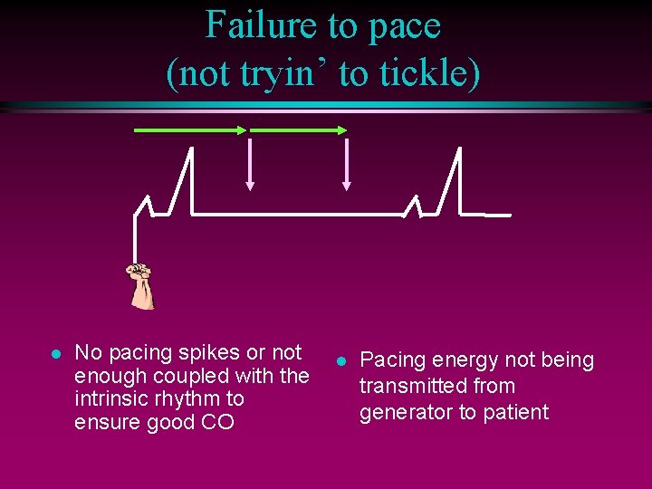 Failure to pace (not tryin’ to tickle) l No pacing spikes or not enough