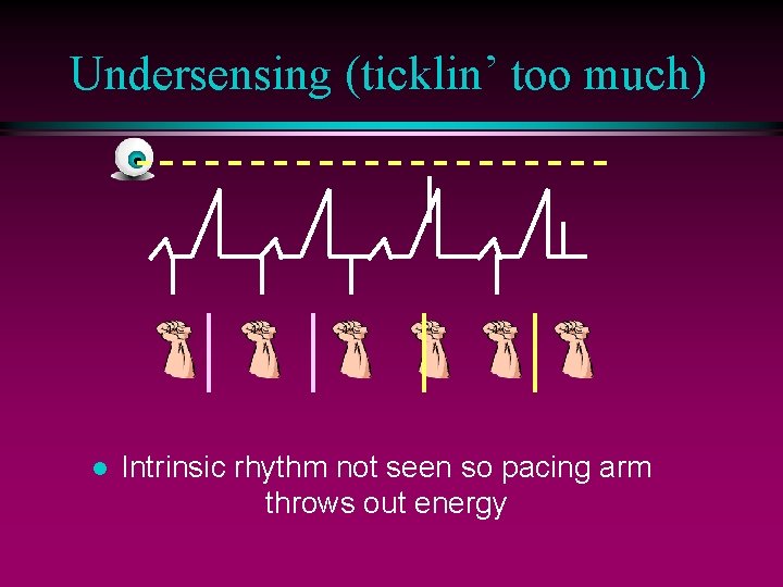 Undersensing (ticklin’ too much) l Intrinsic rhythm not seen so pacing arm throws out