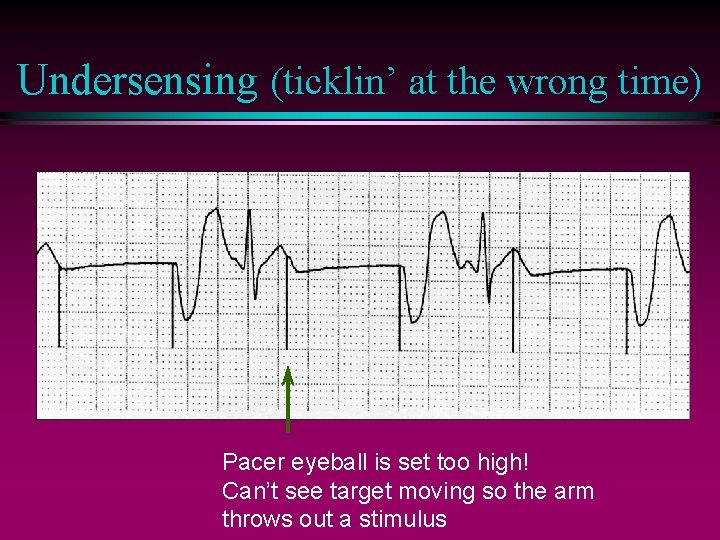 Undersensing (ticklin’ at the wrong time) Pacer eyeball is set too high! Can’t see