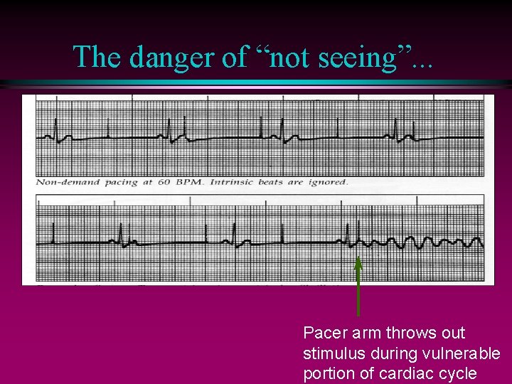 The danger of “not seeing”. . . Pacer arm throws out stimulus during vulnerable
