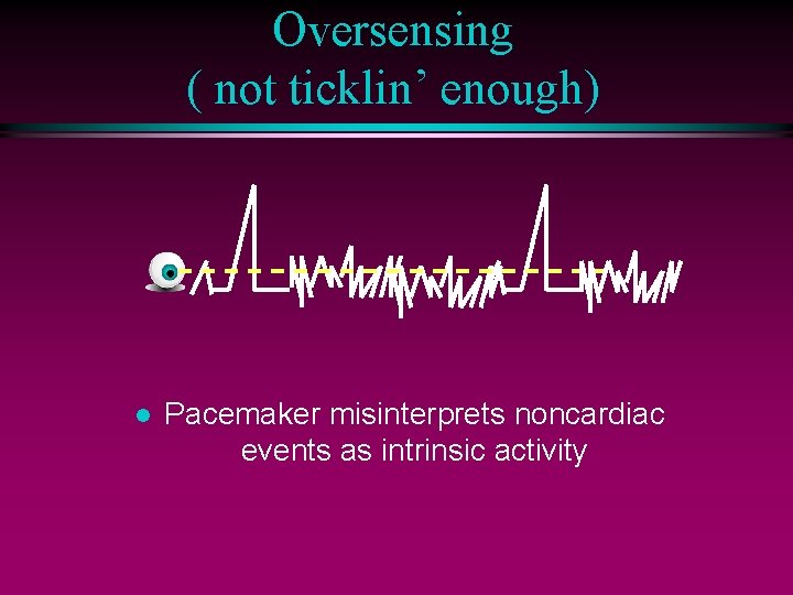 Oversensing ( not ticklin’ enough) l Pacemaker misinterprets noncardiac events as intrinsic activity 