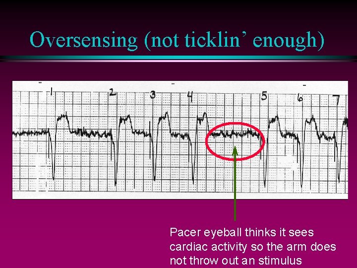 Oversensing (not ticklin’ enough) Pacer eyeball thinks it sees cardiac activity so the arm