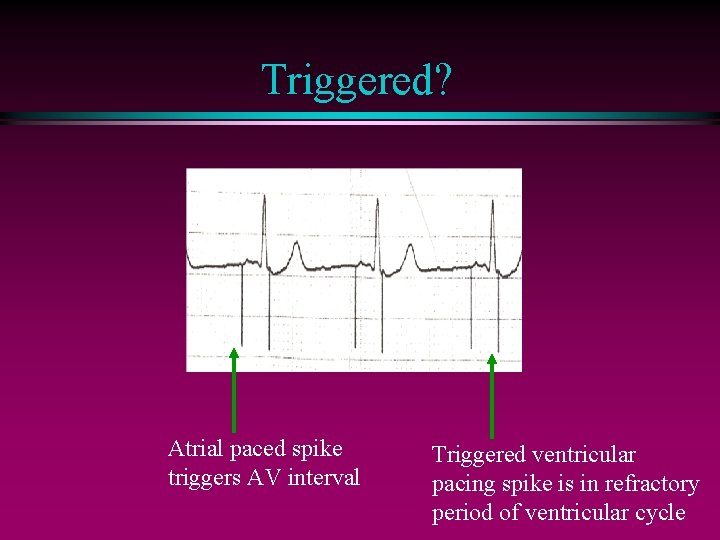 Triggered? Atrial paced spike triggers AV interval Triggered ventricular pacing spike is in refractory
