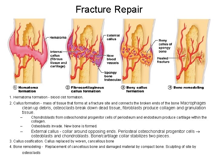 Fracture Repair 1. Hematoma formation - blood clot formation. 2. Callus formation - mass