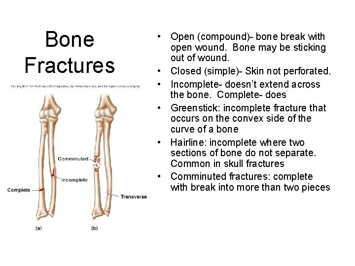 Bone Fractures • Open (compound)- bone break with open wound. Bone may be sticking