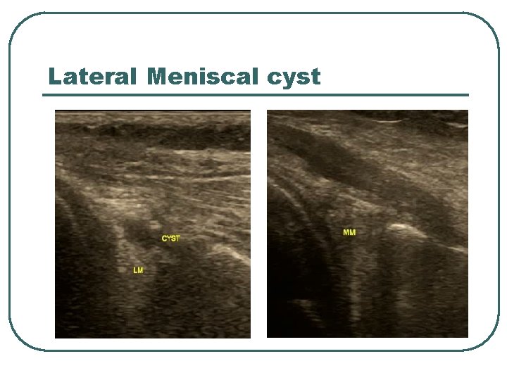 Lateral Meniscal cyst 