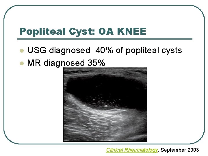 Popliteal Cyst: OA KNEE l l USG diagnosed 40% of popliteal cysts MR diagnosed