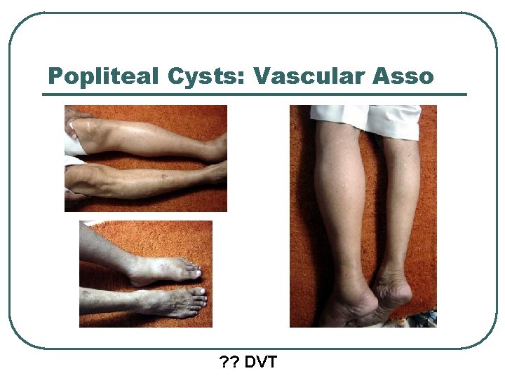 Popliteal Cysts: Vascular Asso ? ? DVT 