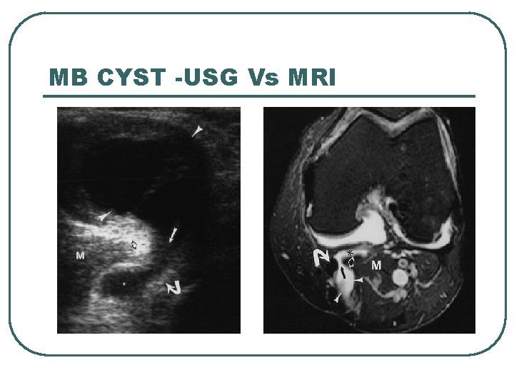 MB CYST -USG Vs MRI 