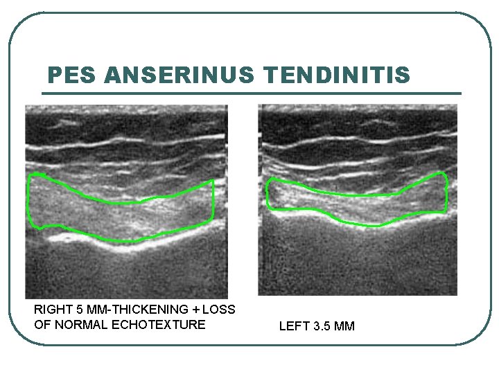 PES ANSERINUS TENDINITIS RIGHT 5 MM-THICKENING + LOSS OF NORMAL ECHOTEXTURE LEFT 3. 5