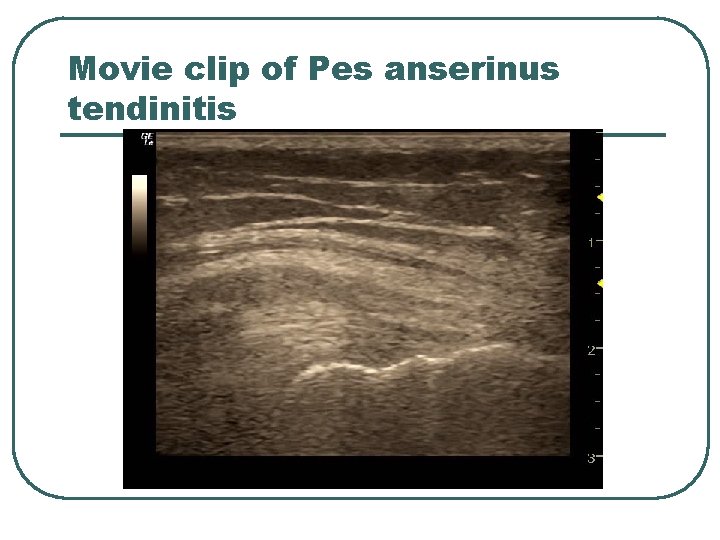 Movie clip of Pes anserinus tendinitis 