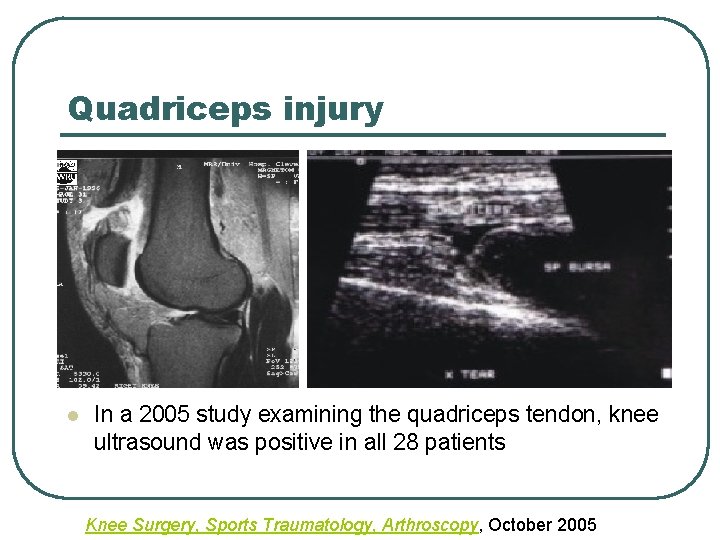 Quadriceps injury l In a 2005 study examining the quadriceps tendon, knee ultrasound was