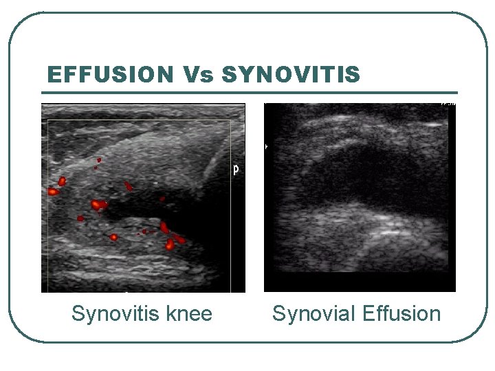 EFFUSION Vs SYNOVITIS Synovitis knee Synovial Effusion 